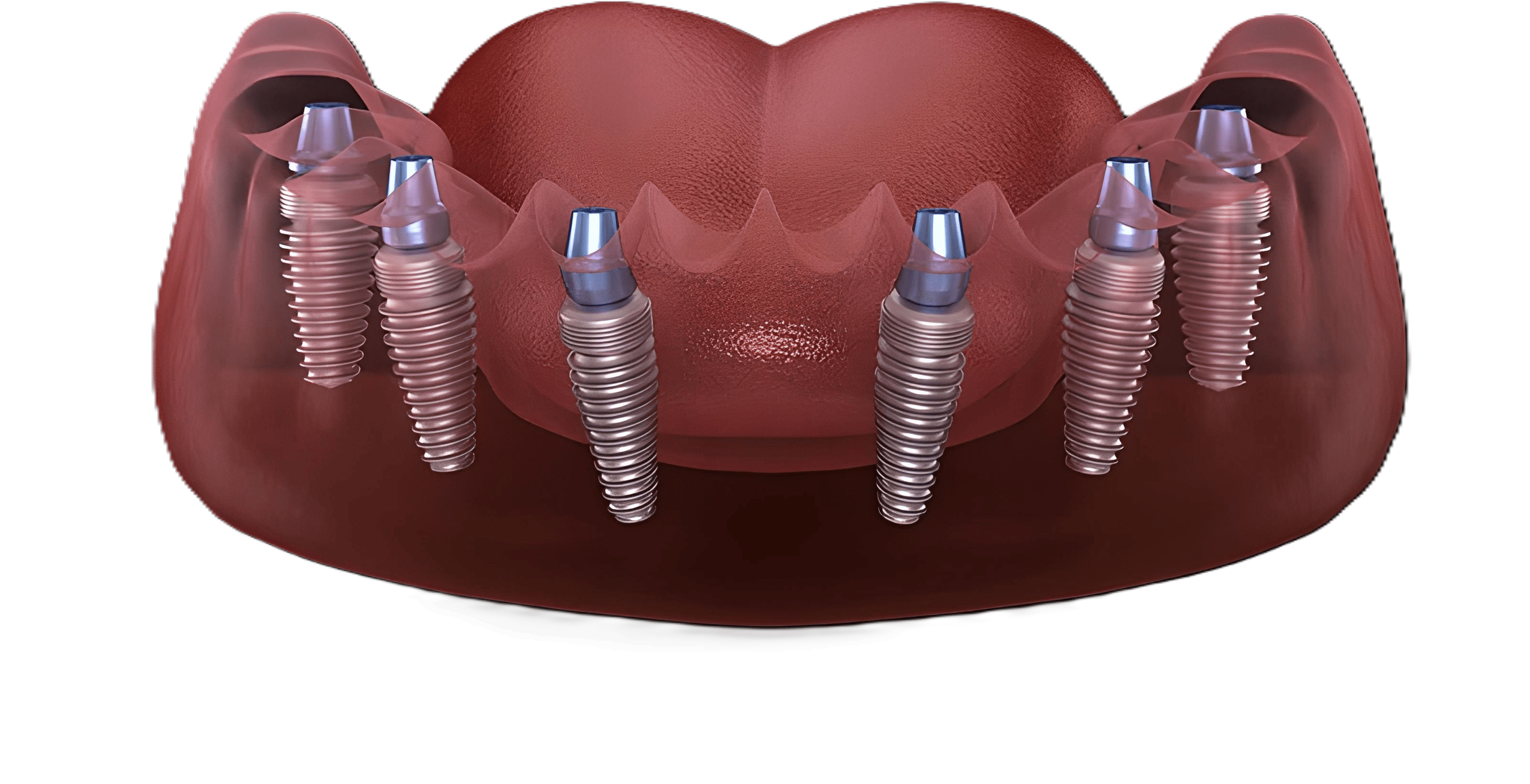 Implantes dentales en clínica