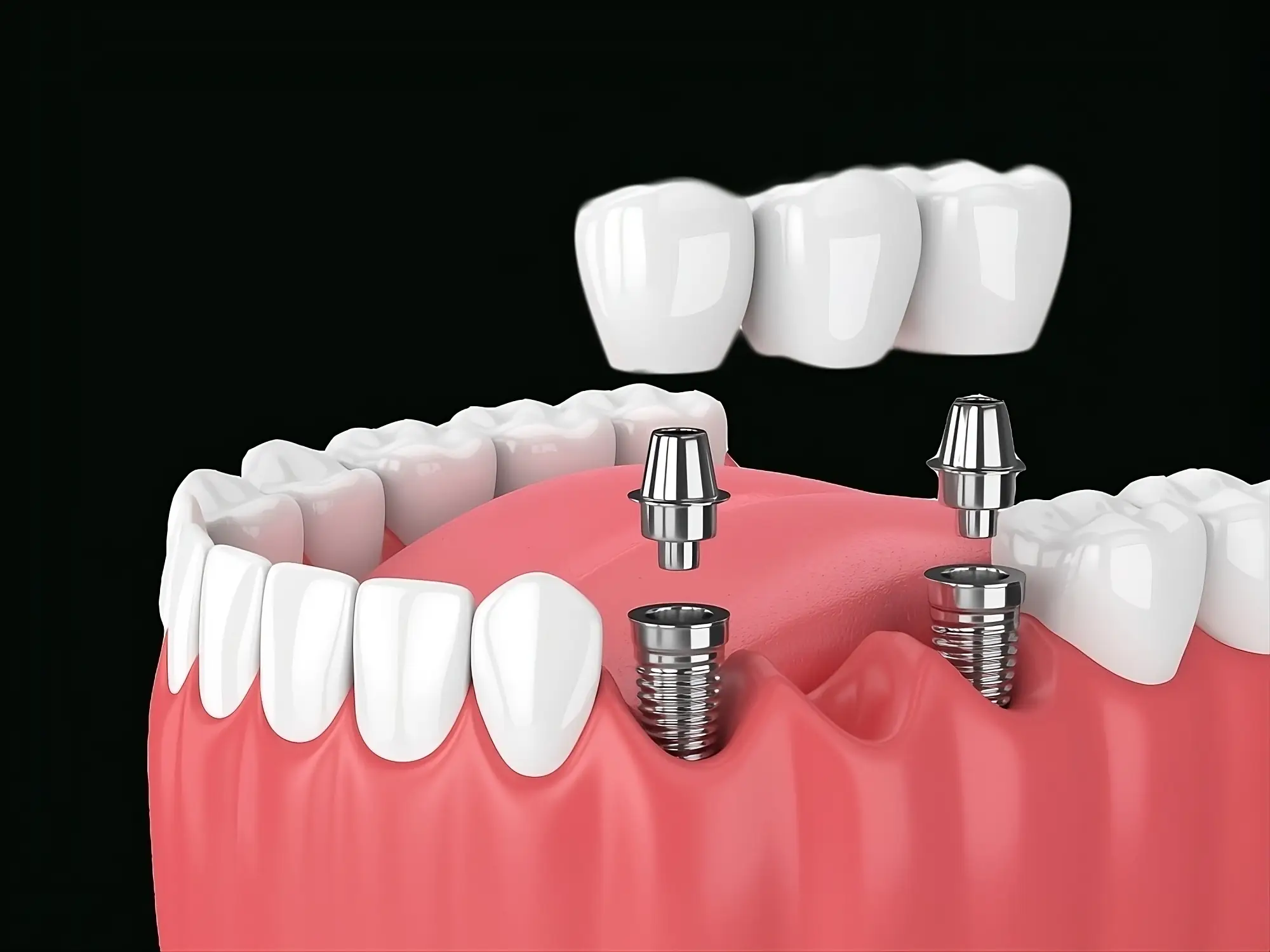 Puente sobre implantes