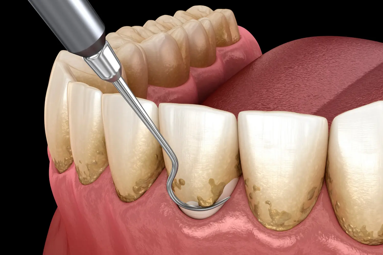 Pulido radicular