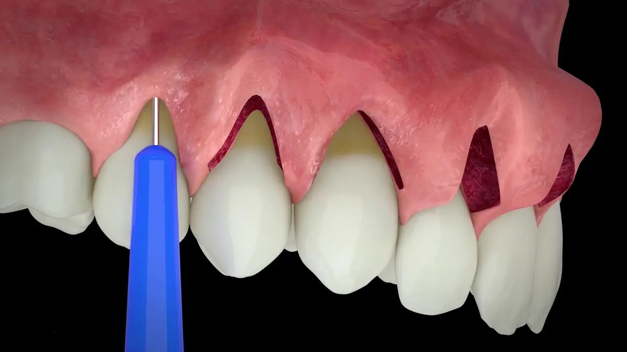 Recesión gingival